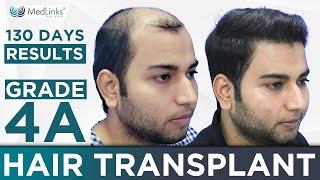 Successful 4500 Grafts Grade 4A | Hair Transplant Before After Results with Testimonial | Medlinks