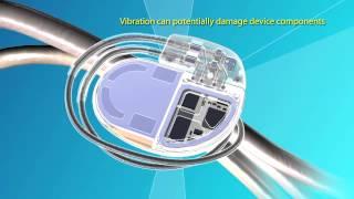 Medtronic Advisa™ DR MRI SureScan™ Pacemaker Video