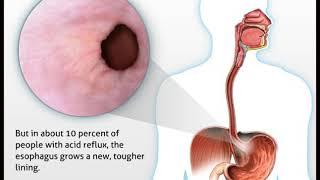 Barrett's esophagus - tutorial