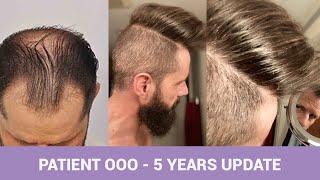 Forhair - Hair Transplant Results - 5 Months Update 2021