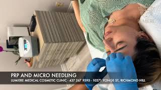 PRP and micro needling