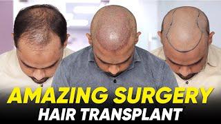 Hair Transplant in Saharanpur | Best Results & Cost of Hair Transplant in Saharanpur