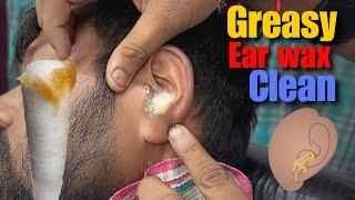 Greasy Ear Wax removed with Hp solution & power Head Massage by Great Shamboo Barber Asmr Ear Clean