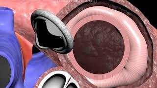 Mitral Valve Replacement Procedure Animation by Cal Shipley, M.D.