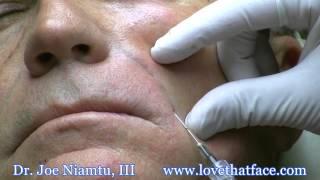 Nasolabial Fold Filler with Cannula by Dr. Joe Niamtu