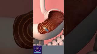 Stomach Endoscopy Procedure - 3D animation