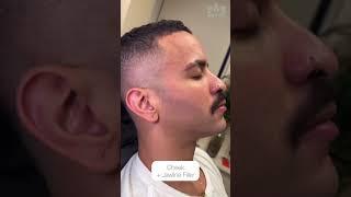 Cheek + Jawline Filler