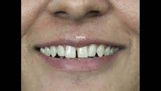 Smile Makeover  for multiple teeth gaps by  Cosmetic Dentist Dr Trivikram Rao