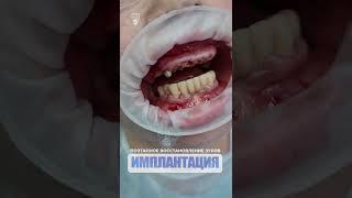 Поэтапное восстановление зубов. Step-by-step restoration of teeth.  Implantation.