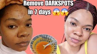 How to remove dark spots,acne & pimples at home. Dark spots Clears in 7 days 100% #acne #diy #scare