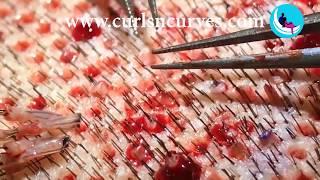 FUE Hair Extraction Method | FUE Hair Transplant in Bangalore.