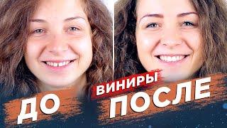 Керамические виниры. Виниры ДО И ПОСЛЕ. Ceramic veneers