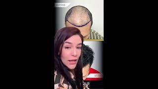 Transplante Capilar en Care4Hair - Consulta Gratis