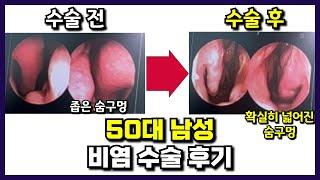 50대 남성 비염 수술후기