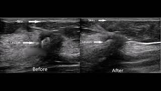 Breast Cryoablation Procedure   Dr  Dennis Holmes