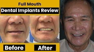 Full Mouth Dental Implants Before And After Review From Germany | Dr. Shahzad Mirza