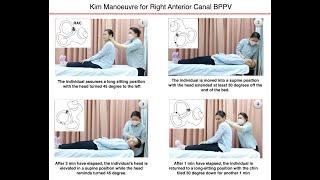 Kim Manoeuvre for Right Anterior Canal BPPV