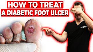 How to Treat a Diabetic Foot Ulcer [Early Signs, Causes & Treatment]