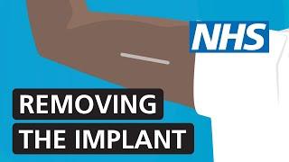 Removing the contraceptive implant | NHS