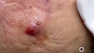 Big Cystic Acne Blackheads Extraction Blackheads & Milia, Whiteheads Removal Pimple Popping