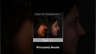 Before and after Rhinoplasty - Dr Guncel Ozturk #rhinoplastyturkey #beforeandafter #drgo #nosejob