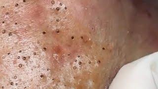 Relax Skincare Everyday with Acne Blackheads Treatment Spa #91015