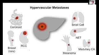 Enhancement-Pattern Approach to Diagnosis of Common Liver Lesions