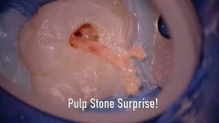 Pulp Stone Surprise! Pulp Stones Can Lead to Calcified Pulp Tissue Inside Canals. Check This Out!