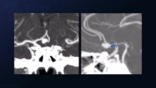 Clip Reconstruction of an Anterior Communicating Artery Aneurysm
