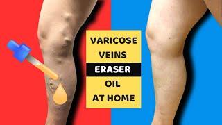 Varicose Vein ERASER OIL ️ HEAL & RELIEVE Pain From Varicose Veins & Spider Veins