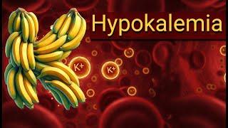 Low Potassium Uncovered: 7 Signs, Causes and Treatment -  Hypokalemia