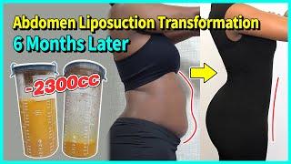 FULL Abdominal Liposuction Experience  | Girin Plastic Surgery