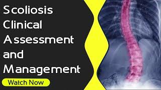 Scoliosis - Clinical Assessment and Management | Orthopaedic Academy