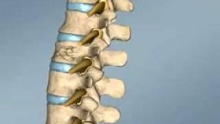 Spine Surgery Croatia - Vertebroplasty