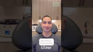 Before + After: Botox with Chemical Peel