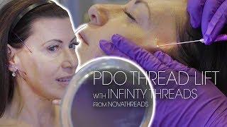 NovaThreads Infinity Thread Lift | PDO Threads for Jawline Contouring