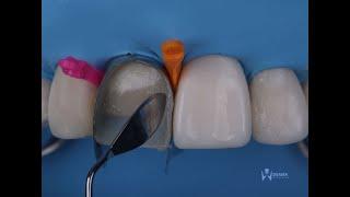 direct composite veneers with layering technique