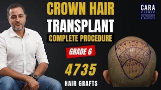 Crown hair transplant | crown hair restoration in India by Dr. Asif | Cara clinic mumbai