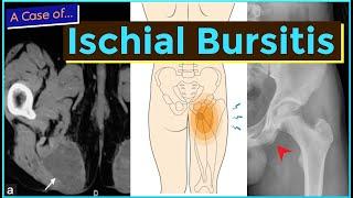 Ischial Bursitis