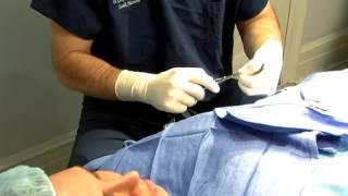 Dr. Sterry Talks About Liposuction