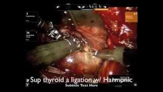 Robotic thyroidectomy by Ho-Sheng Lin, MD