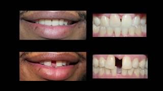 Invisaign for Teeth Gap Treatment at Cosmetic Dental Associates