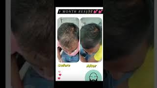 Hair loss treatment in Zirakpur l The Skin Zeal | Dr. Isha V. Mittal | Call 72-93-93-93-26