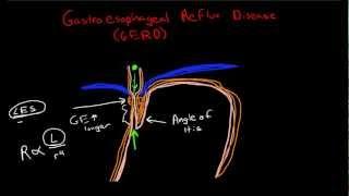 Pathophysiology of Gastroesophageal Reflux Disease (GERD)