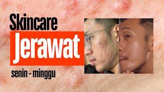 Cara Pakai Skincare untuk jerawat