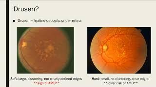 Vision Loss and Macular Degeneration