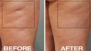 New tool to fight cellulite