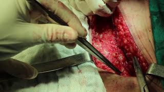 Parto cesariano / Cesarean delivery