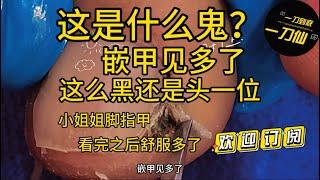 pedicure tutorial：trimming ingrowm nails修指甲小姐姐脚指甲脚趾甲美甲修甲嵌甲处理过程asmr