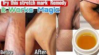 Effective way to clear STRETCH MARKS  FASTER/ Remove Stretch marks very fast #stretchmarksremoval